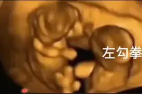 双胎宝宝子宫内打架，出生后浑身淤青？武汉专家：只是普通胎记，“打架”一说不靠谱图片