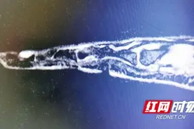 湖南省中医院：手指无外伤却“一碰就痛”？警惕这种肿瘤图片