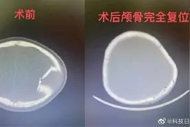 地震致1岁女孩颅骨凹陷碎裂 救援队专家紧急手术图片