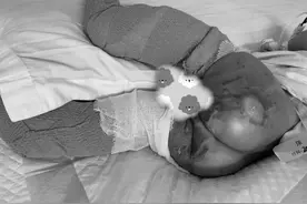 两个月大婴儿被大面积烫伤 潍坊市人民医院医生：帮就帮到底图片