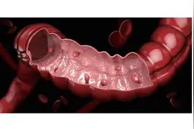 大肠息肉：不做肠镜你看不到我！图片