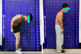 身体90度弯曲5年没法抬头看天，“折叠人”终于挺直腰杆了图片