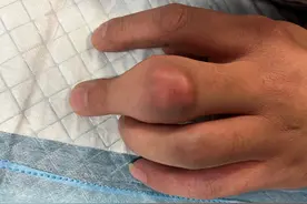 管不住嘴，手指竟长出“石头”？图片