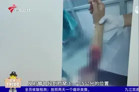 深圳：男子醉酒后一拳打爆玻璃门 胳膊被“削”剩一层皮视频封面