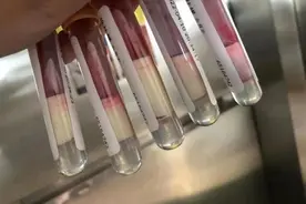 8岁女孩抽出来的血像牛奶一样！原因成谜图片