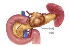 为什么胰腺癌被称为“癌中之王”？图片