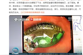 听着都疼！啤酒瓶盖卡喉咙，男子硬吞馒头咽下……图片