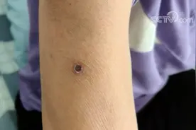 手臂长“黑痣”？小心！可能是患了这种病图片