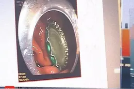 “土方法”不一定靠谱！啤酒瓶盖卡喉，男子用馒头硬送下去图片