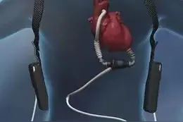 世界心脏日｜“人工心脏”可以令患者“起死回生”吗？图片