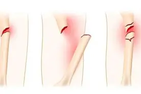 假期出游，小心这种“最凶险的骨折”图片