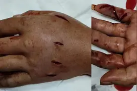 吓人！台州男子露营被蛇咬了一口，整只手肿胀淤青，医院紧急注射8支血清……图片