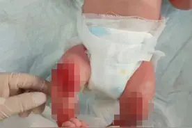 太心疼！“蝴蝶宝贝”，皮肤一碰就碎，任何触碰都成为痛苦……图片