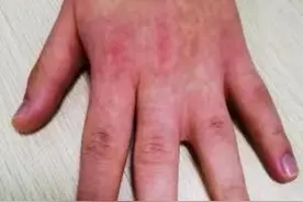 男子食指和中指“粘连”25年，医师精细手术为他成功矫正图片