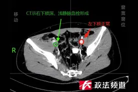 20岁小伙用筋膜枪按摩半小时，第二天进了医院危及生命图片