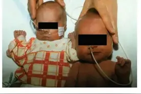 浙江双胞胎姐妹出生竟差了整整一个月！姐姐牺牲了自己，让妹妹健康降生图片