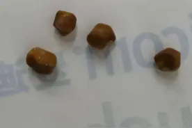 胆结石、肾结石 医生提醒：有些结石会拖成癌图片