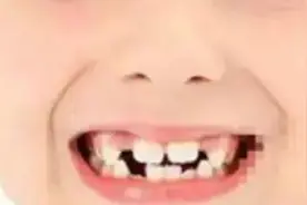 为牙缝太大而烦恼？如何预防和修复来听专业解答→图片