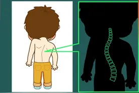 「转扩」孩子脊柱侧弯吗？一套自我检测方法送给您图片