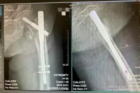 百岁老人骨折怎么办？上海四院创伤骨科让她重新行走图片