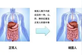 极为罕见！13岁女孩内脏全长反了图片
