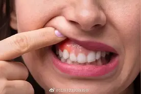 牙龈炎症是青少年常见的口腔疾病，该如何预防？图片