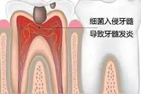 牙痛的“绝密武器”——根管治疗图片