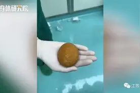 重100克！男子排尿疼痛，医生取出结石大如鹅蛋，几乎占满膀胱图片