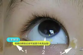 6种症状提醒你该查血脂了！照着吃悄悄降低你的血脂图片