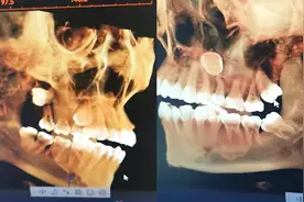 女子智齿“叛逆”横长在颧骨中：诊所推荐去找华西医院的主任或教授拔视频封面