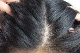 很多人喜欢抠头皮上的小颗粒，到底是什么东西啊？图片