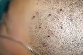 触目惊心！11岁女童被伤了近80处，紧急抢救图片