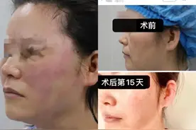 免费体验6万元医美项目后感染，新氧、元美回应图片