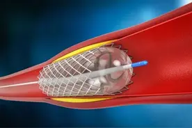 冠状动脉严重狭窄可以不放支架么？图片