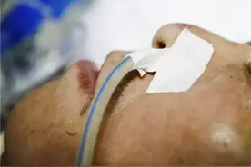 留置胃管鼻贴花式贴法，有对比有真相图片