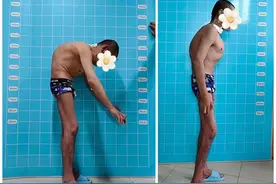 告别20多年“折叠人生”，他终于可以“抬头挺胸”图片