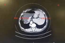 瑞金病例│ 这台大手术，医生们全都“反”着来……图片