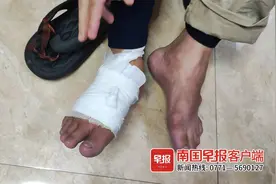 男子因脚痛风石入院治疗，不料动脉和肌腱断了！谁之过？图片