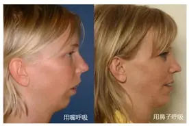 鼻炎患者自学4招，让鼻子快速通气图片