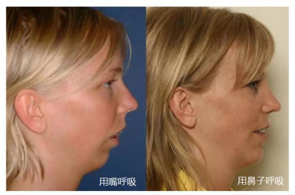轻微鼻炎怎么办（鼻炎患者自学4招）