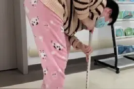 21岁“折叠女孩”贴地行走，医生一次手术打开双髋关节图片