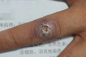 52岁男子洗鱼时被扎伤，手指长疙瘩疼痛不止，竟是它作祟图片