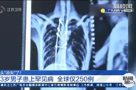 1米8变成1米7，23岁男子骨头竟然“消失”了！一查竟是患上这种病……图片