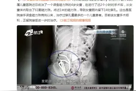 浙江一4岁女童误吞61颗磁力珠，致胃肠道14处穿孔图片