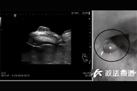 孩子爱咬嘴唇？警惕这种疾病图片