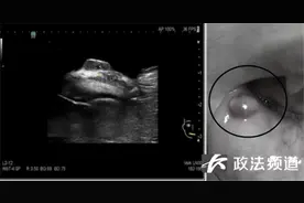 孩子爱咬嘴唇？警惕这种疾病图片