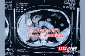 女子体检发现结石未治 六年间结石狂增5倍达4.1cm图片