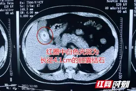 女子体检发现结石未治 六年间结石狂增5倍达4.1cm图片