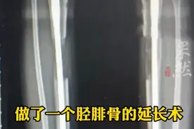 19岁女生断骨增高后无法行走，医生：致残率极高图片