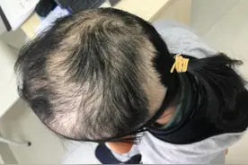 两年多不间断心理“云”护理，“拔毛症”女孩留起了秀发图片